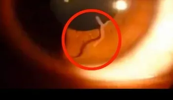 Doctor mira el interior  ojo de mujer y descubre algo que está causando asombro (VIDEO)