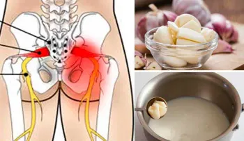 Si sufres de ciática, este remedio es buenísimo 