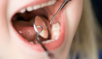 9 mitos y verdades sobre las caries
