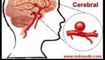 Aneurisma Cerebral 