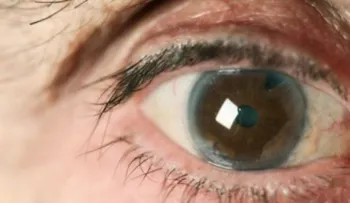 Niños malnutridos son susceptibles a padecer cataratas y glaucomas