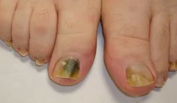 Este es el Mejor Remedio Para Eliminar Los Hongos De Las Uñas