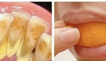La receta para eliminar el sarro y blanquear tus dientes que un dentista nunca te dirás