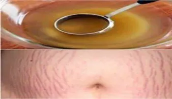Un ingrediente mágico para las estrías después del parto!