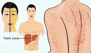 10 síntomas de que tu Hígado está fallando y la mayoria los ignora