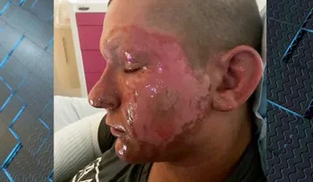 Aparecen misteriosas quemaduras en la cara de un adolescente tras rozar una planta tóxica