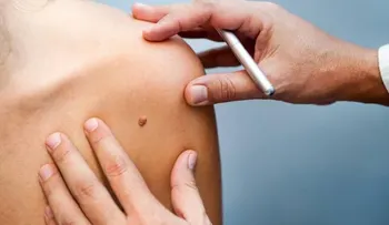 Diseñan un sistema para detectar al "patito feo" que puede acabar en melanoma