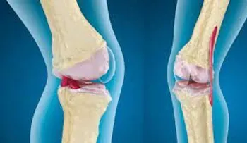 Remedio natural y efectivo para aliviar el dolor de rodillas, huesos y articulaciones