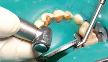 Pulpotomía en Niños: Tratamiento que Repara el Corazón del Diente