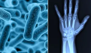Dolor de articulaciones está relacionado con bacterias en el intestino