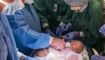 Separan a siameses de cinco meses en la Florida 