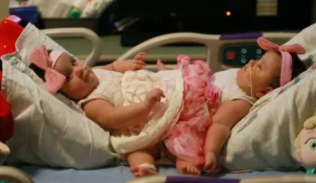 Separan a hermanas siamesas en compleja operación de más de 12 horas