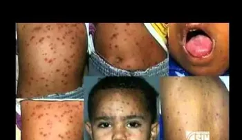 Conozca el virus que en la adultez puede ser fatal (VIDEO)