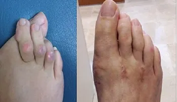 Los médicos lo confirman: Dí adiós a la artritis con este último remedio