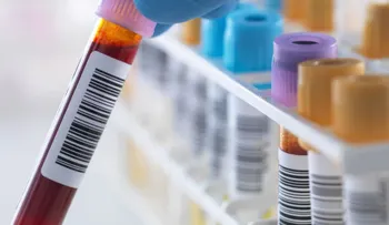 Inyectan 3,1 millones para diagnosticar el Alzheimer con análisis de sangre