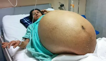 El antes y después de la mujer con tumor más grande del mundo