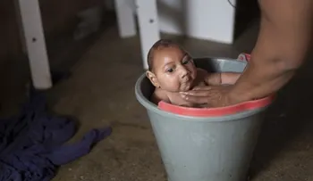 Mueren en Brasil 5 bebés con malformación causada por el zika