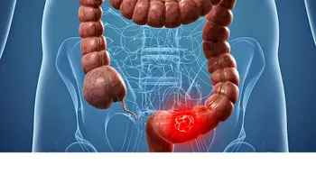El cáncer colorrectal, una enfermedad que puede confundirse con colitis