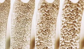 Crean medicamento que restaura huesos para combatir la osteoporosis