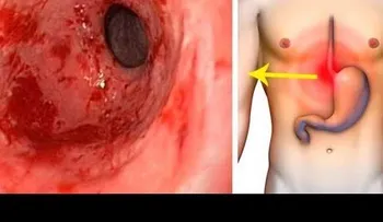 Un remedio que no falla para eliminar la gastritis y la acidez estomacal para siempre