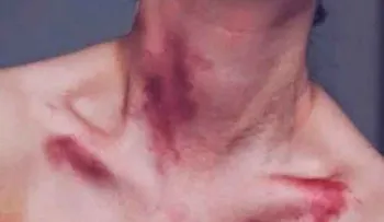 Si te gusta hacer o que te hagan chupetones, lee esto
