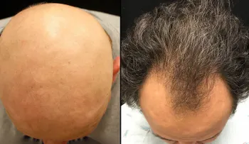 Esta droga podría revertir un tipo de calvicie masculina