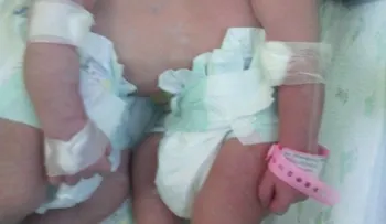 Nacen siamesas unidas por el abdomen en el hospital Cabral y Báez 