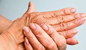 5 alimentos que no debes comer si tienes artritis psoriásica