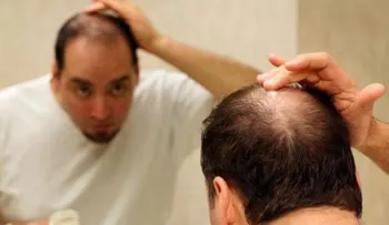 Este hombre tuvo resultados increíbles mezclando plátanos, cerveza, huevo y miel para evitar caída del cabello