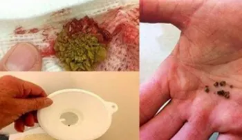 Elimina para siempre las piedras del riñón con este increíble remedio