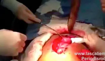 Sacan un pez vivo intestino de un hombre (Video)