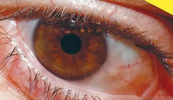 La retinopatía diabética es la segunda causa de ceguera