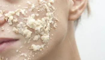 Dile adiós a las espinillas y el acné con esta mascarilla