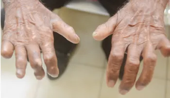 Cura de la lepra es un desafío por cumplir