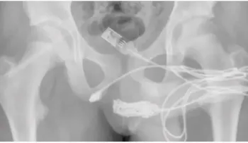 Joven que se introdujo cable USB en el pene, puede desarrollar un estrechamiento de la uretra