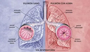 Para el asma, bronquitis, tos y enfermedades pulmonares