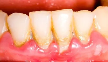 Como eliminar la placa dental con remedios naturales