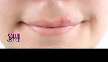Como frenar un Herpes Labial en una sola noche con este sencillo Truco Natural