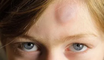 9 soluciones naturales para tratar los moretones