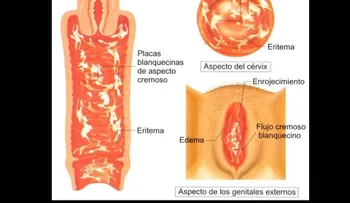 Cómo deshacerse para siempre de los hongos vaginales: ANOTA