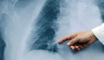  Cáncer de pulmón es uno de los más frecuentes en hombres 
