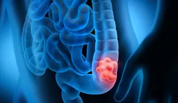 Importancia de realizar pruebas genéticas en pacientes con cáncer de colón