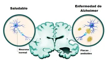 10 cosas que debes hacer para prevenir la enfermedad de Alzheimer