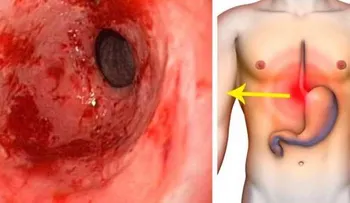 Potente remedio para eliminar la gastritis y la acidez estomacal