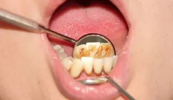 El sarro de los dientes; remedios efectivos para quitarlo
