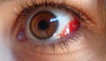 Si tiene los ojos así de rojos, sal corriendo donde un doctor: se trata de algo muy grave 
