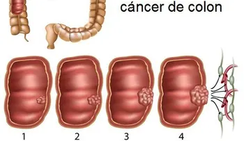 Síntomas de cáncer de colon que no debes ignorar
