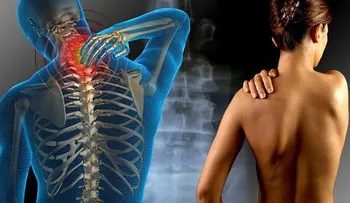 ¿Qué debes saber sobre la fibromialgia?   