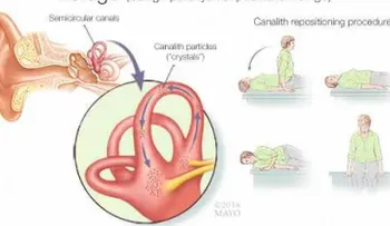 Mareo provocado por los cristales del oído interno
