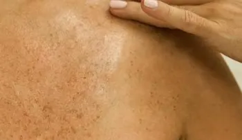 Reduce las manchas de la piel de forma segura